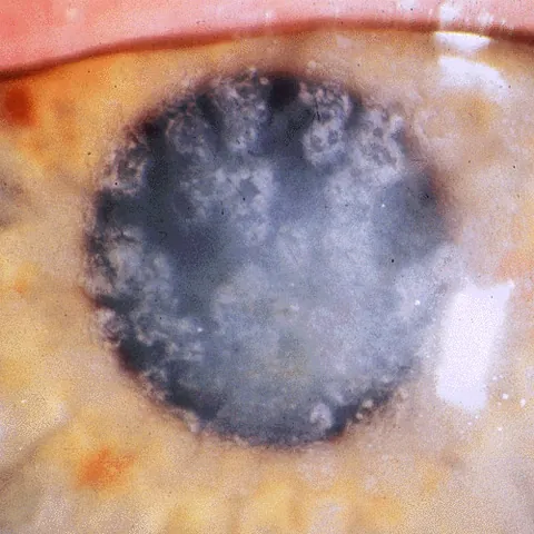corneal dystrophy: a group of genetic diseases which cause overgrowth and malformation of the cornea