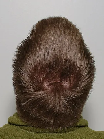 cowlick: an unruly lock or section of hair that sticks straight out from the skull or lies at an angle at...