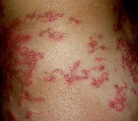 creeping eruption: a skin disease caused by the movement of certain species of ancylostomatids under the skin