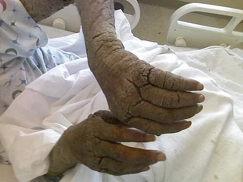 crusted scabies: a form of scabies in immunocompromised patients, causing a scaly rash and thick crusts of...