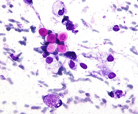 cryptococcosis: a serious and potentially fatal fungal disease caused by members of the Cryptococcus neoformans...