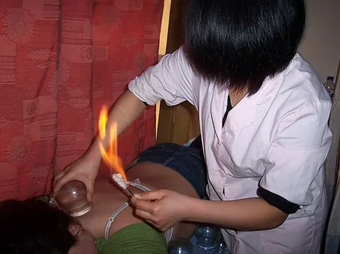 cupping therapy: a form of traditional medicine in which a cup of heated air is placed against the skin