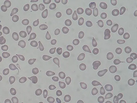 dacrocyte: a type of poikilocyte that is shaped like a teardrop