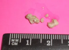 dacryolith: a concretion of material in a lacrymal or nasal duct
