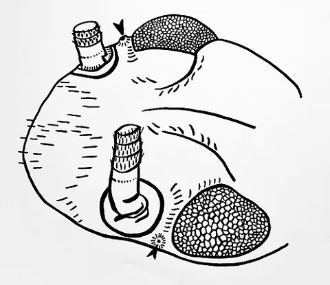 organ of tömösváry: a specialized pair of sensory organs found in certain groups of myriapods and hexapods, located on...