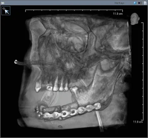 dentition: the set of natural teeth of an individual