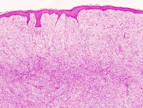 dermatofibrosarcoma protuberans: a rare, slow-growing skin cancer that starts in the deeper layers of the skin. It typically appears...