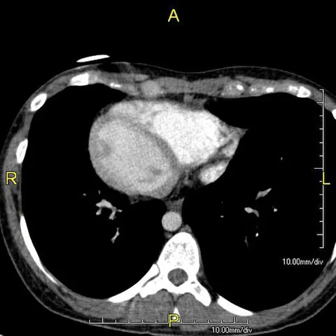 dextrocardia: a congenital abnormality in which the heart is transposed to the right side of the chest