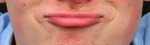 duckface: a facial expression in which the lips are pushed outwards in a pout
