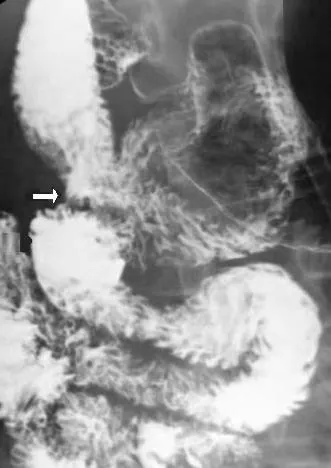 duodenojejunostomy: a surgical procedure that creates a anastomosis between the duodenum and the jejunum to bypass a...