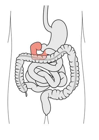 duodenum: the first part of the small intestine, starting at the lower end of the stomach and extending to...