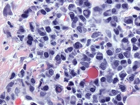 dutcher body: one of the periodic acid-Schiff reaction-positive nuclear inclusions, containing immunoglobulin,...