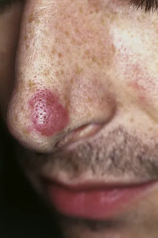 peau d'orange: human skin with the appearance and dimpled texture of an orange peel, associated with some medical...
