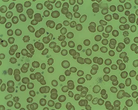 echinocyte: a red blood cell with abnormal appearance characterized by many small, evenly spaced thorny...