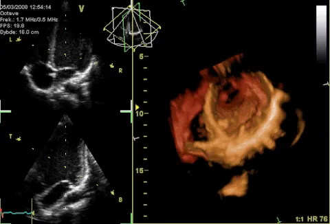 echocardiogram: the visual image formed by an echocardiograph