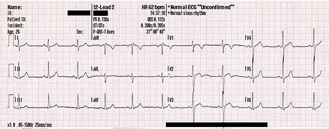 electrocardiogram: the recording that an electrocardiograph produces