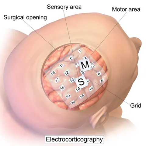 electrocorticography: a technique that records the brain's electrical activity using electrodes placed directly on the...