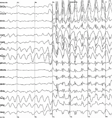 electroencephalography: the measurement and recording of electrical activity in the brain for diagnostic purposes