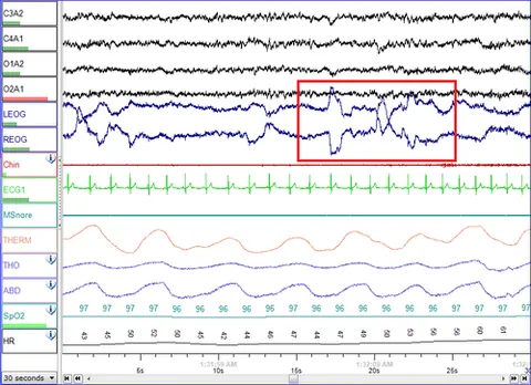 electrooculography: the recording and measurement of the electrical potential generated by the eye, especially to...