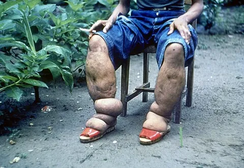 elephantiasis: a complication of chronic filariasis, in which nematode worms block the lymphatic vessels, usually...