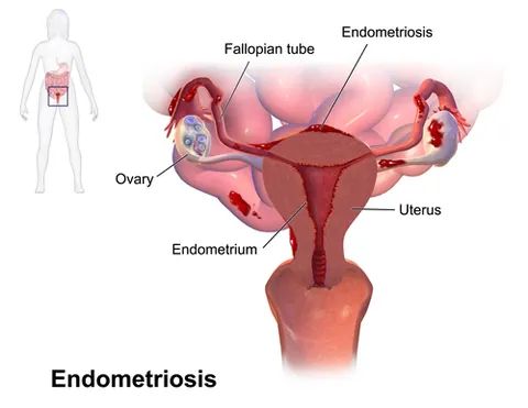 endometriosis: a generally painful condition characterised by the presence of endometrial-like tissue in places...