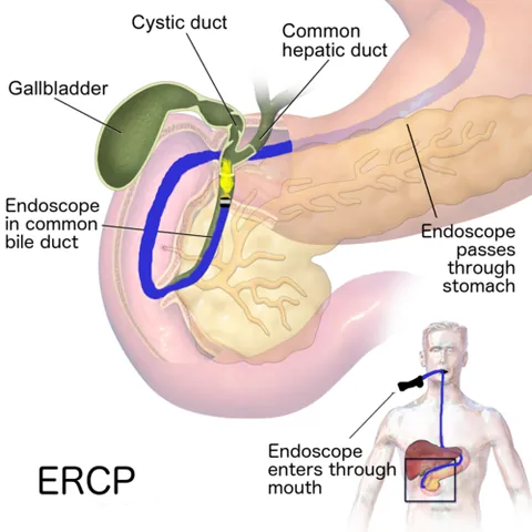 endoscopic retrograde cholangiopancreatography: a specialized procedure that combines endoscopy and X-ray imaging to both diagnose and treat...