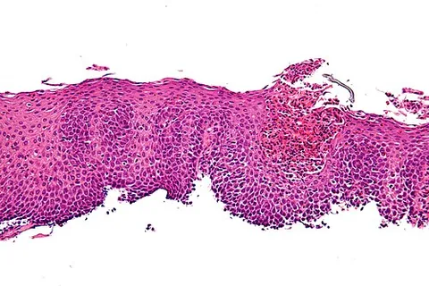 eosinophilic esophagitis: a chronic inflammatory disease where eosinophils build up in the lining of the esophagus, usually...