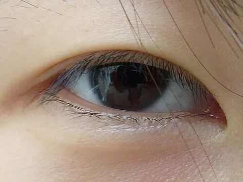 epicanthic: that partially covers the inner angle of the eye