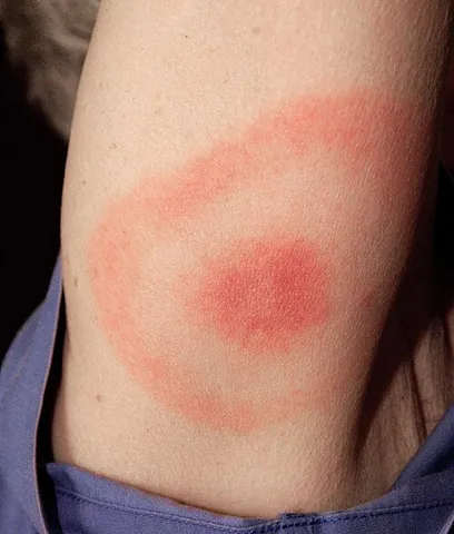 erythema migrans: the rash often seen in the early stage of Lyme disease