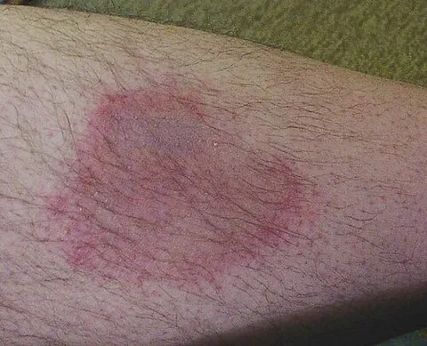 erythema: abnormal redness and inflammation of the skin, due to vasodilation