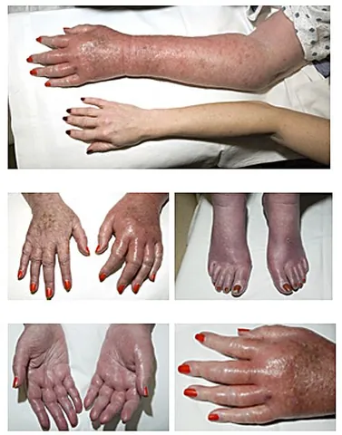 erythromelalgia: a rare neurovascular peripheral pain disorder in which blood vessels, usually in the lower...
