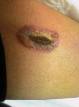 eschar: a superficial structure of dead tissue, usually hardened, and commonly but not necessarily dark,...