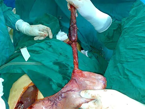 esophagectomy: the surgical procedure for the removal of all, or part of the esophagus