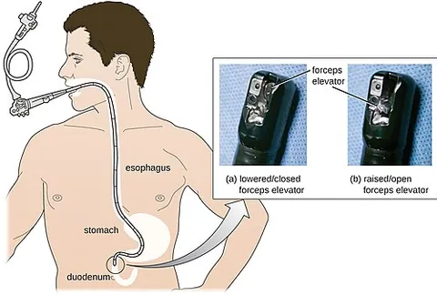 esophagogastroduodenoscopy: a medical procedure in which a endoscope is inserted through the mouth to visually examine the...