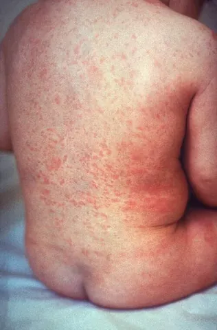exanthem: a widespread rash usually occurring in children