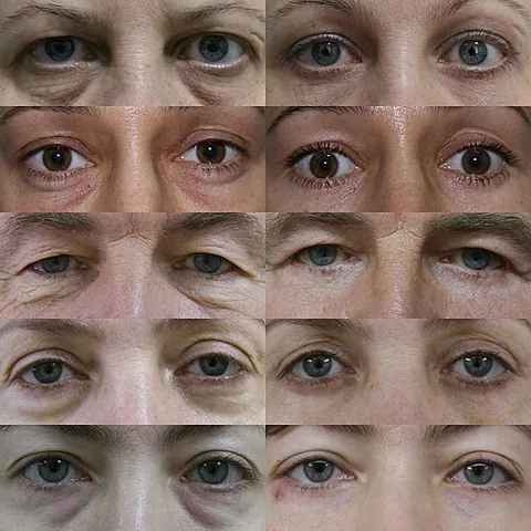 eye job: a plastic surgical procedure to alter the appearance of the eyelid(s), especially for cosmetic...