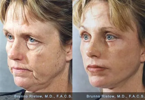 face job: a plastic surgical procedure to alter the appearance of the face, particularly for cosmetic reasons