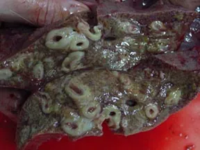 fascioliasis: infestation with liver flukes (of genus Fasciola)