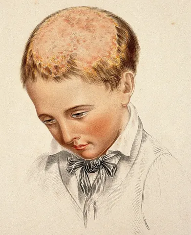 favus: a severe, chronic infection of ringworm