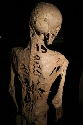 fibrodysplasia ossificans progressiva: a very rare, disabling genetic disorder of the connective tissue in which fibrous tissue (including...
