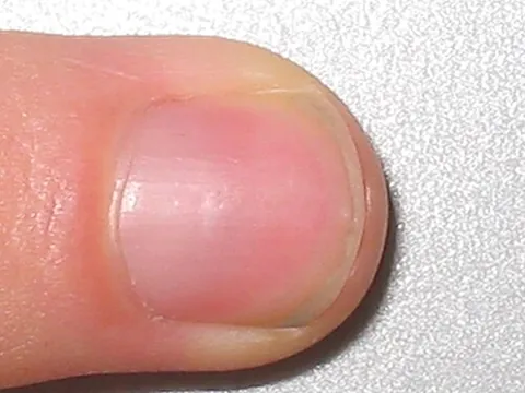 fingernail: the hard, flat translucent covering near the tip of a human finger, useful for scratching and fine...