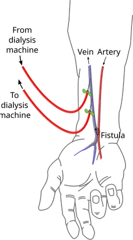 fistula: an abnormal connection or passageway between organs or vessels that normally do not connect