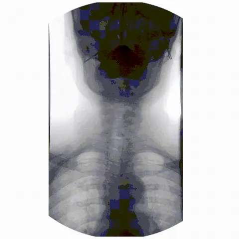fluoroscopy: examination using a fluoroscope
