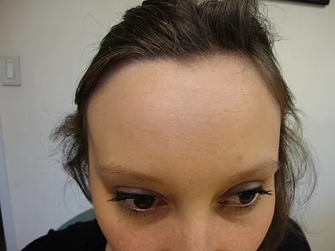 forehead: the part of the face above the eyebrows and below the hairline
