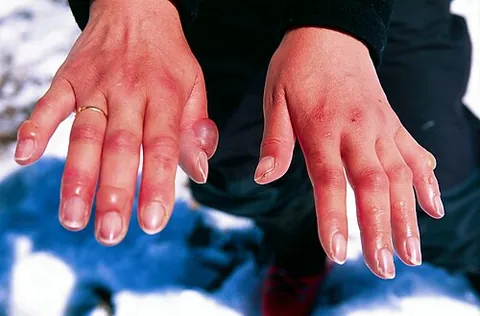 frostbite: an injury suffered as a result of freezing of some part of the body, typically fingers, toes or the...