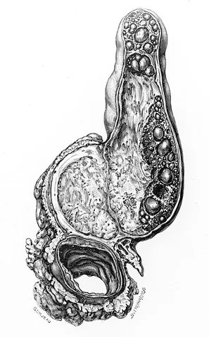 gallbladder cancer: an uncommon form of cancer targeting the gallbladder