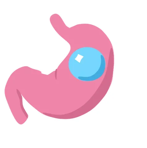 gastric balloon: a temporary, non-surgical weight loss device placed inside the stomach to help a person feel full...