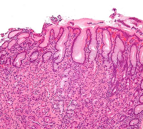 gastritis: inflammation of the lining of the stomach, characterised by nausea, loss of appetite, and upper...