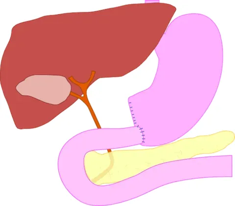 gastroduodenostomy: a surgical procedure in which the stomach is connected directly to the duodenum, usually after part...