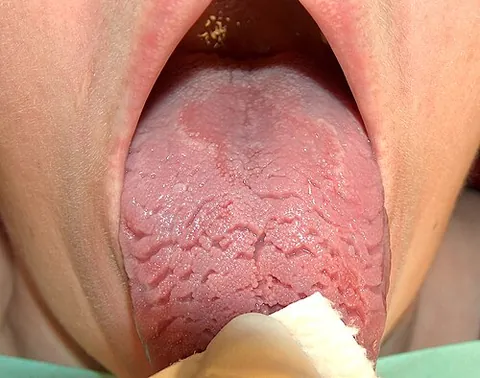 geographic tongue: an inflammatory condition of the mucous membrane of the tongue, usually on the dorsal surface